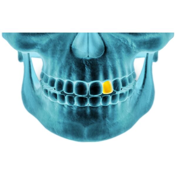 XRAY Golt Tooth Thumbnail